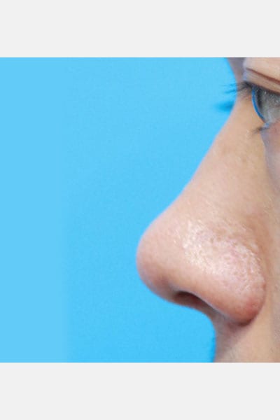 Asian Rhinoplasty in Walnut Creek, CA - Patient After 1