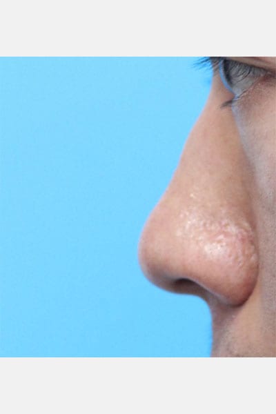 Asian Rhinoplasty in Walnut Creek, CA - Patient Before 1