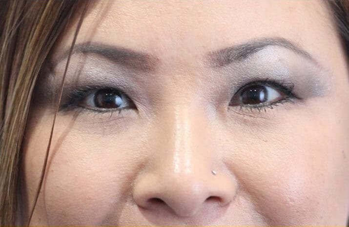 Asian Blepharoplasty in Walnut Creek, CA - Patient After 2