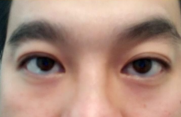 Asian Blepharoplasty in Walnut Creek, CA - Patient After 1