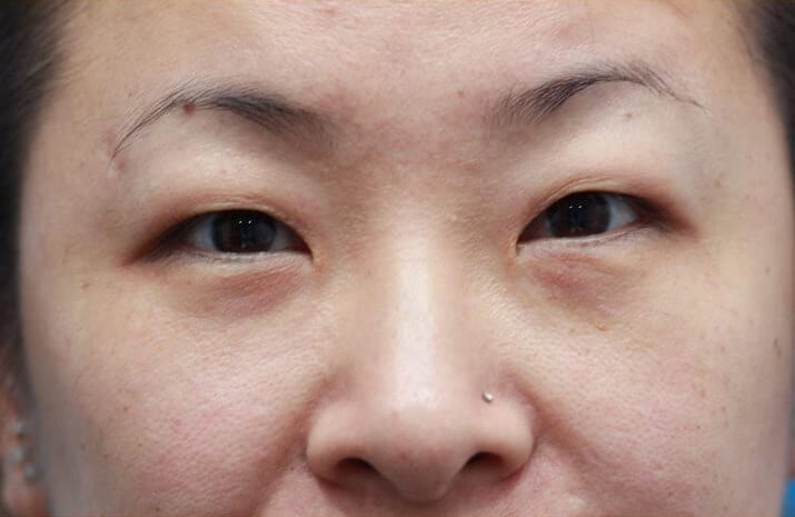 Asian Blepharoplasty in Walnut Creek, CA - Patient Before 2