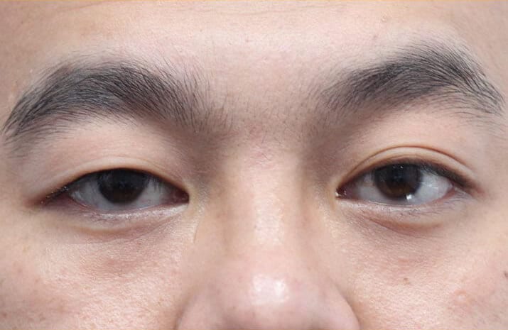 Asian Blepharoplasty in Walnut Creek, CA - Patient Before 1