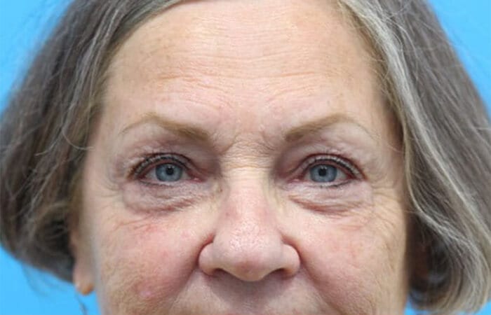 Blepharoplasty in Walnut Creek - Patient After 2