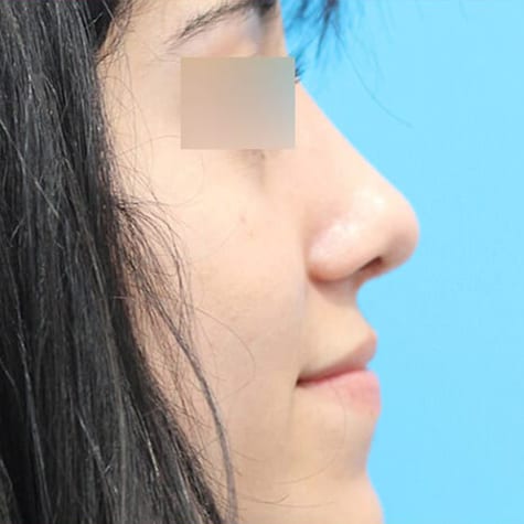 Rhinoplasty in Walnut Creek - Patient After 1