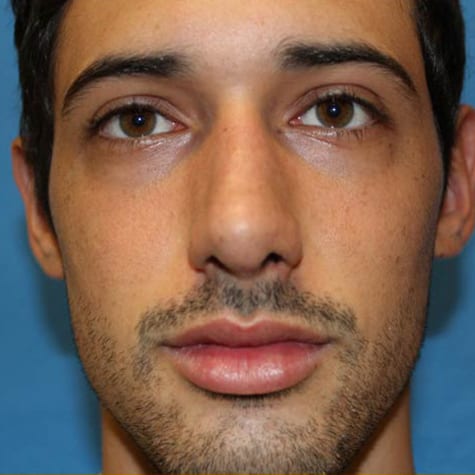 Rhinoplasty in Walnut Creek - Patient After 2