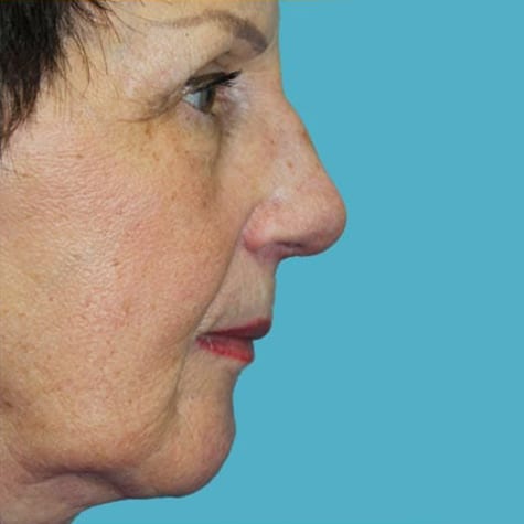 Rhinoplasty in Walnut Creek - Patient After 3