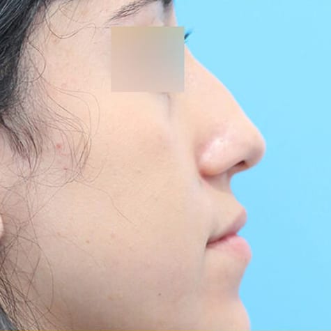 Rhinoplasty in Walnut Creek - Patient Before 1