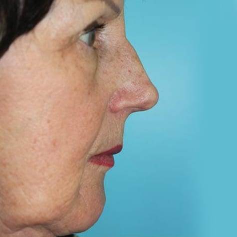 Rhinoplasty in Walnut Creek - Patient Before 3