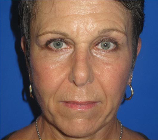 Facelift in Walnut Creek, CA - Patient After 1