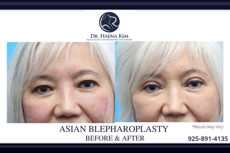 Asian eyelid surgery before and after performed in Walnut Creek, CA.