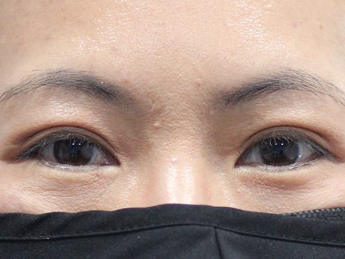 Asian Blepharoplasty After Patient 1