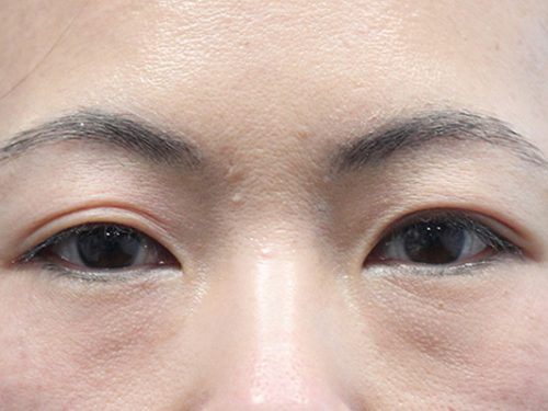 Asian Blepharoplasty Before Patient 1