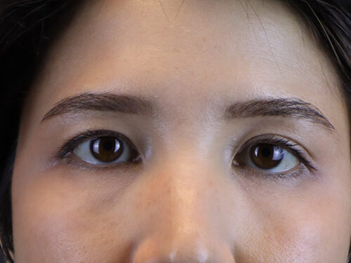 Asian Blepharoplasty Before Patient 1