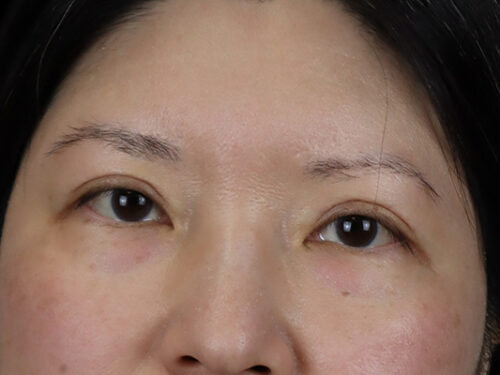 Asian Blepharoplasty After Patient 1