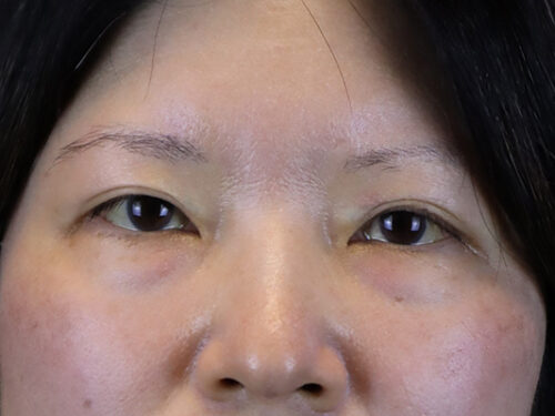 Asian Blepharoplasty Before Patient 1
