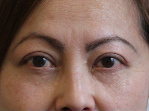 Asian Blepharoplasty After Patient 11