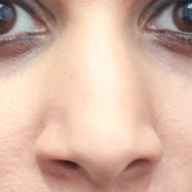 Asian Rhinoplasty Before Patient 1