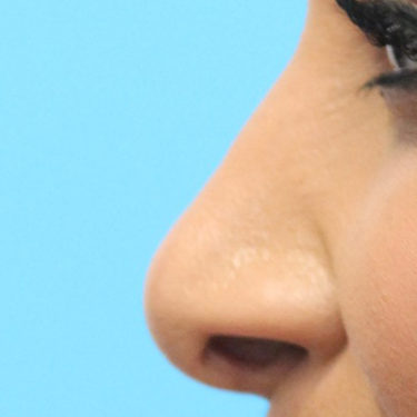 Asian Rhinoplasty After Patient 2