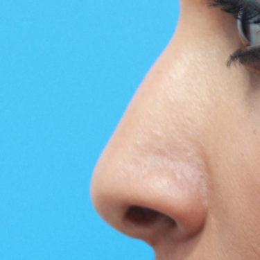 Asian Rhinoplasty Before Patient 2