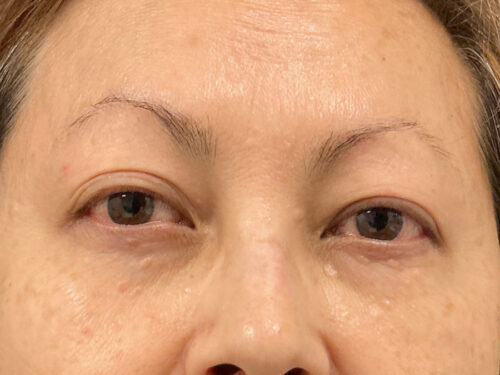 Asian Blepharoplasty Before Patient 11