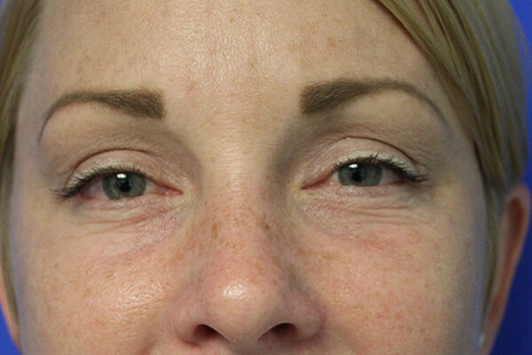 Lower Blepharoplasty (Lower Eyelid Surgery) in Walnut Creek, CA - Patient After 1