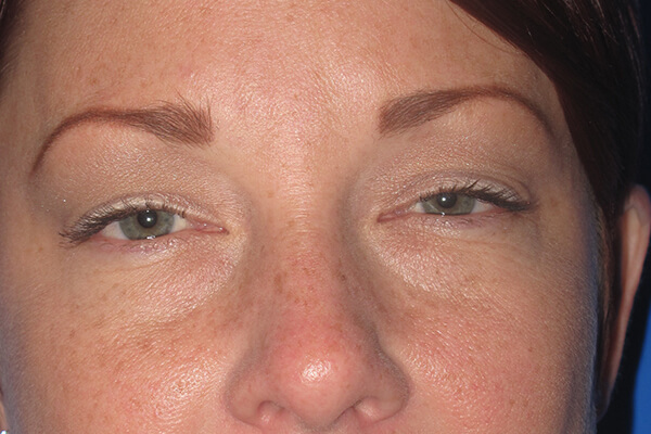 Lower Blepharoplasty (Lower Eyelid Surgery) in Walnut Creek, CA - Patient Before 1