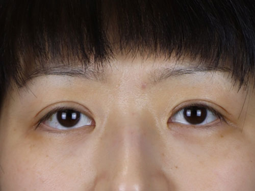 Asian Blepharoplasty After Patient 10