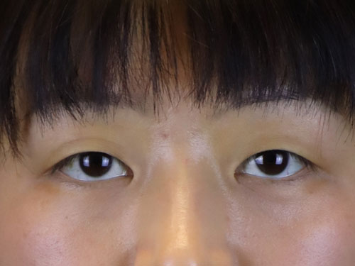 Asian Blepharoplasty Before Patient 10