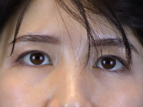 Asian Blepharoplasty After Patient 1