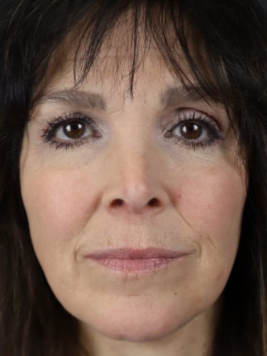 Necklift/Facelift After Patient 4