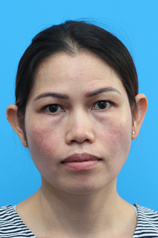 Otoplasty in Walnut Creek, CA - Patient Before 2