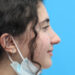 Rhinoplasty After Patient Thumbnail 2
