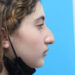 Rhinoplasty Before Patient Thumbnail 2